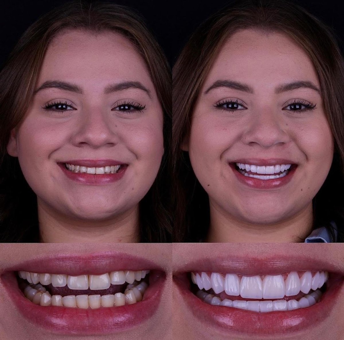Hollywood Smile przed i po – licówki dla jaśniejszych, równych zębów
