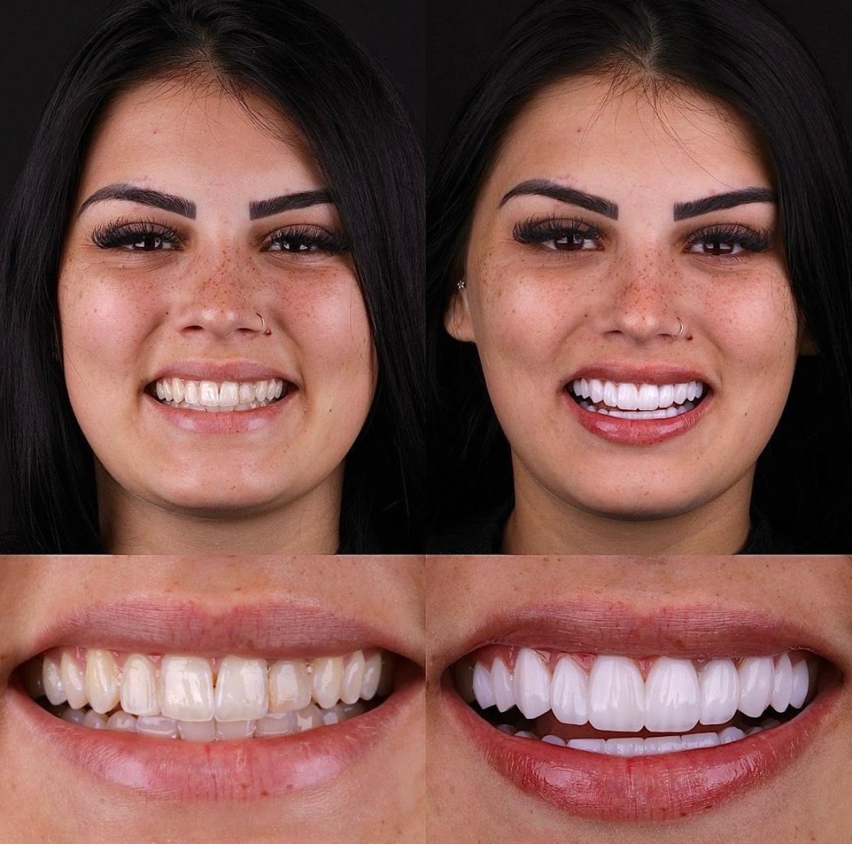 Hollywood Smile before and after results – brighter, even teeth after dental veneers procedure