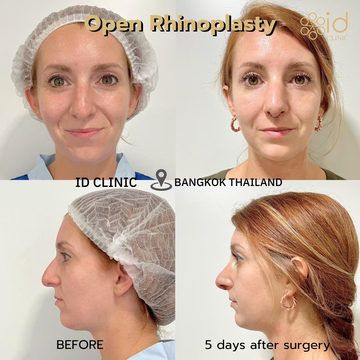 Before and after open rhinoplasty results at ID Clinic Bangkok, nose reshaping in 5 days
