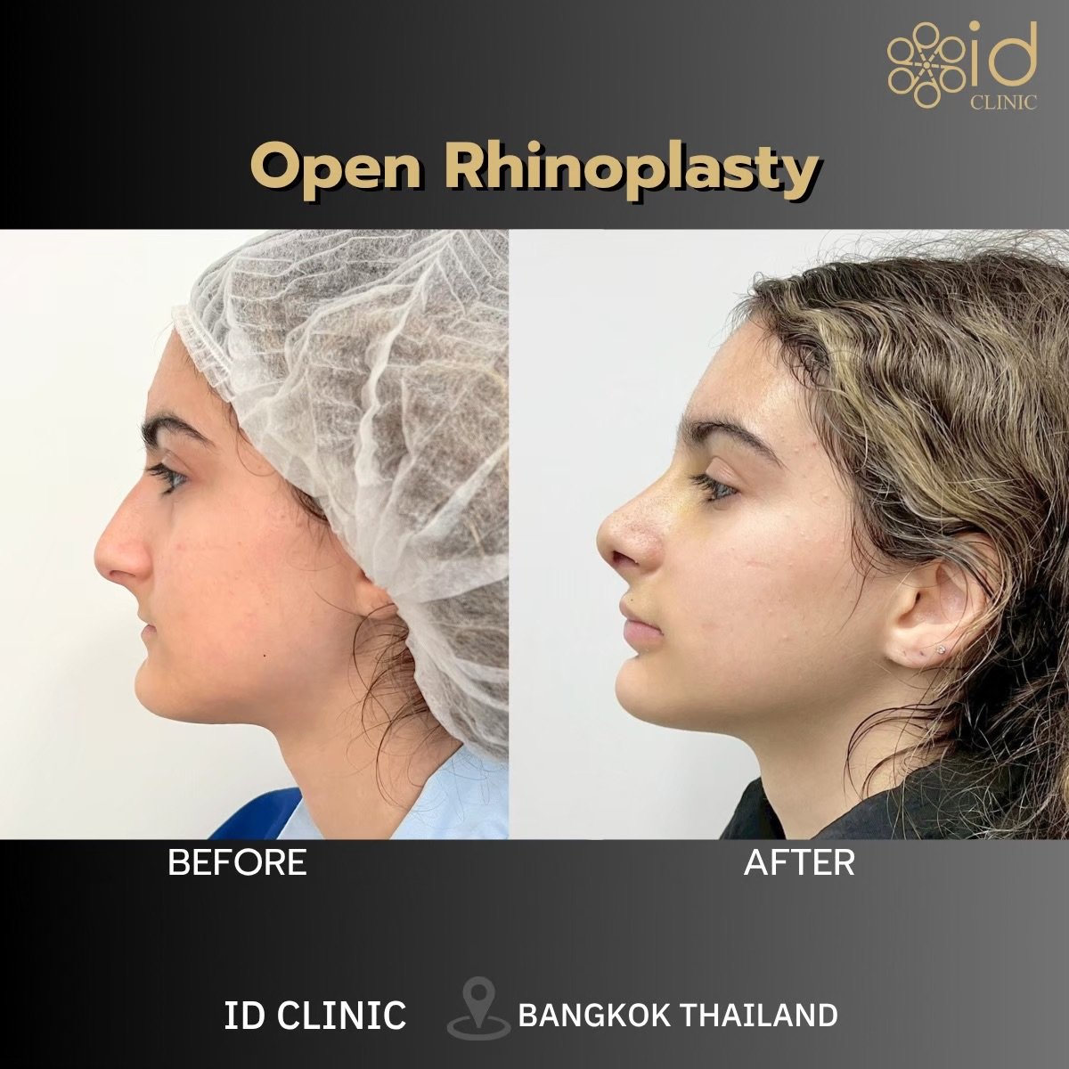 Before and after open rhinoplasty results at ID Clinic Bangkok, nose reshaping improvement