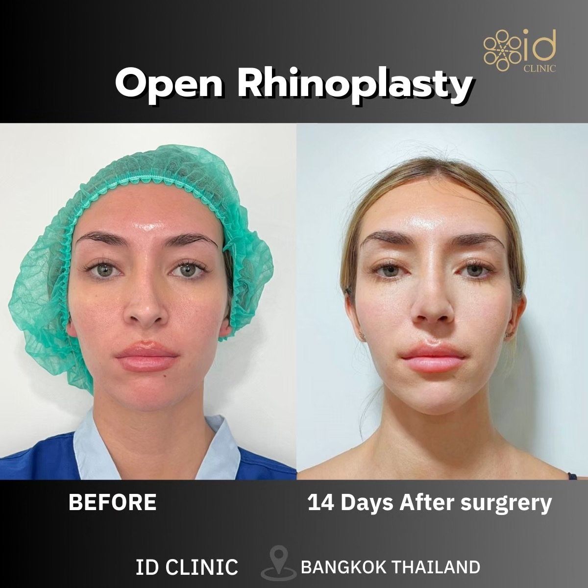 Before and after open rhinoplasty results at ID Clinic Bangkok, 14 days post-surgery