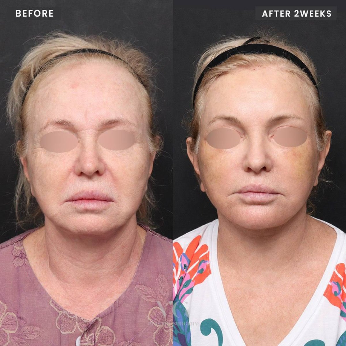 نتائج شد الوجه العميق قبل وبعد في VG Plastic Surgery، تجديد شباب الوجه بوضوح