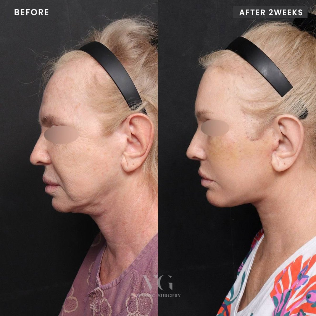 نتائج شد الوجه العميق قبل وبعد في VG Plastic Surgery، تجديد شباب الوجه بوضوح