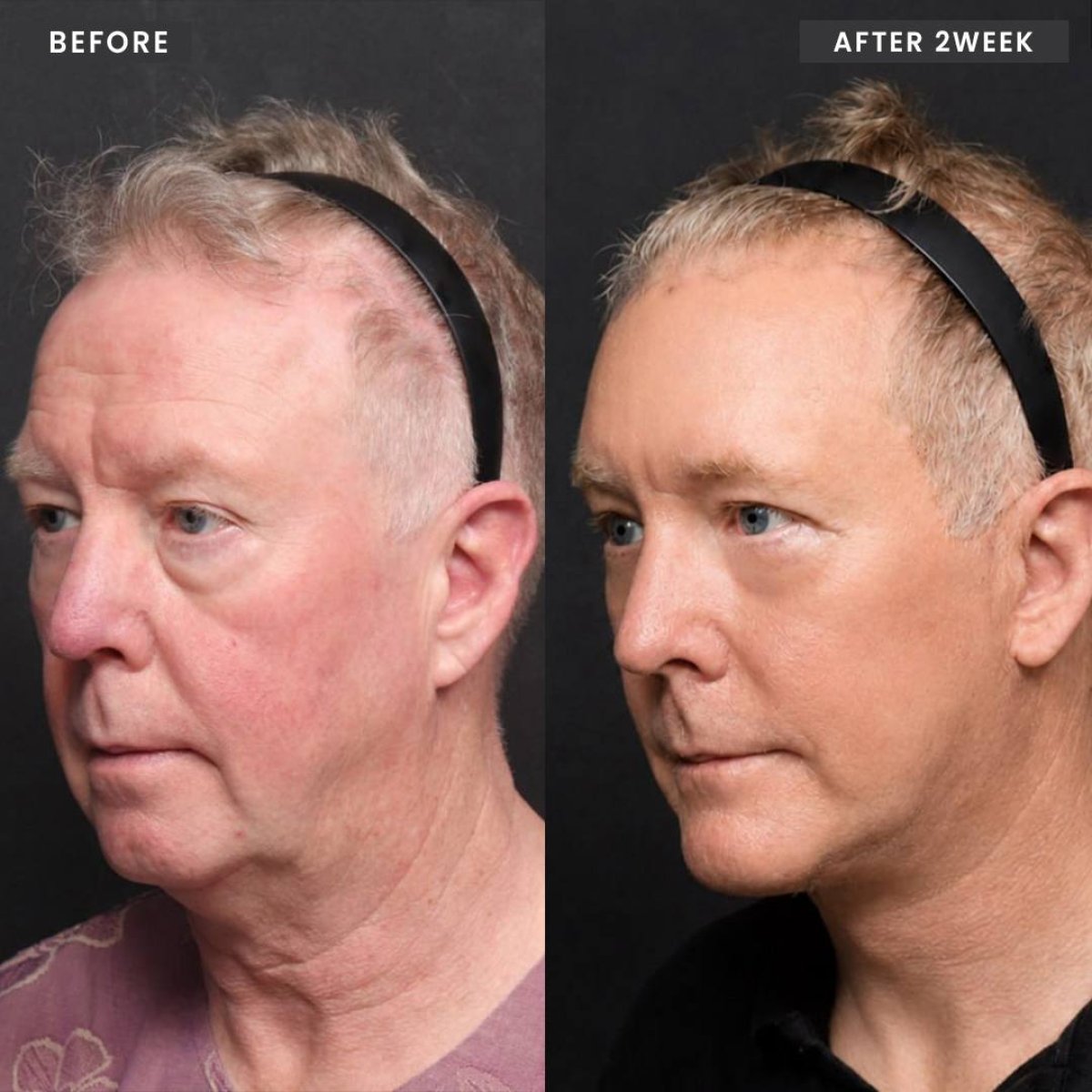 نتائج قبل وبعد شد الوجه العميق في VG Plastic Surgery، تجديد واضح للوجه