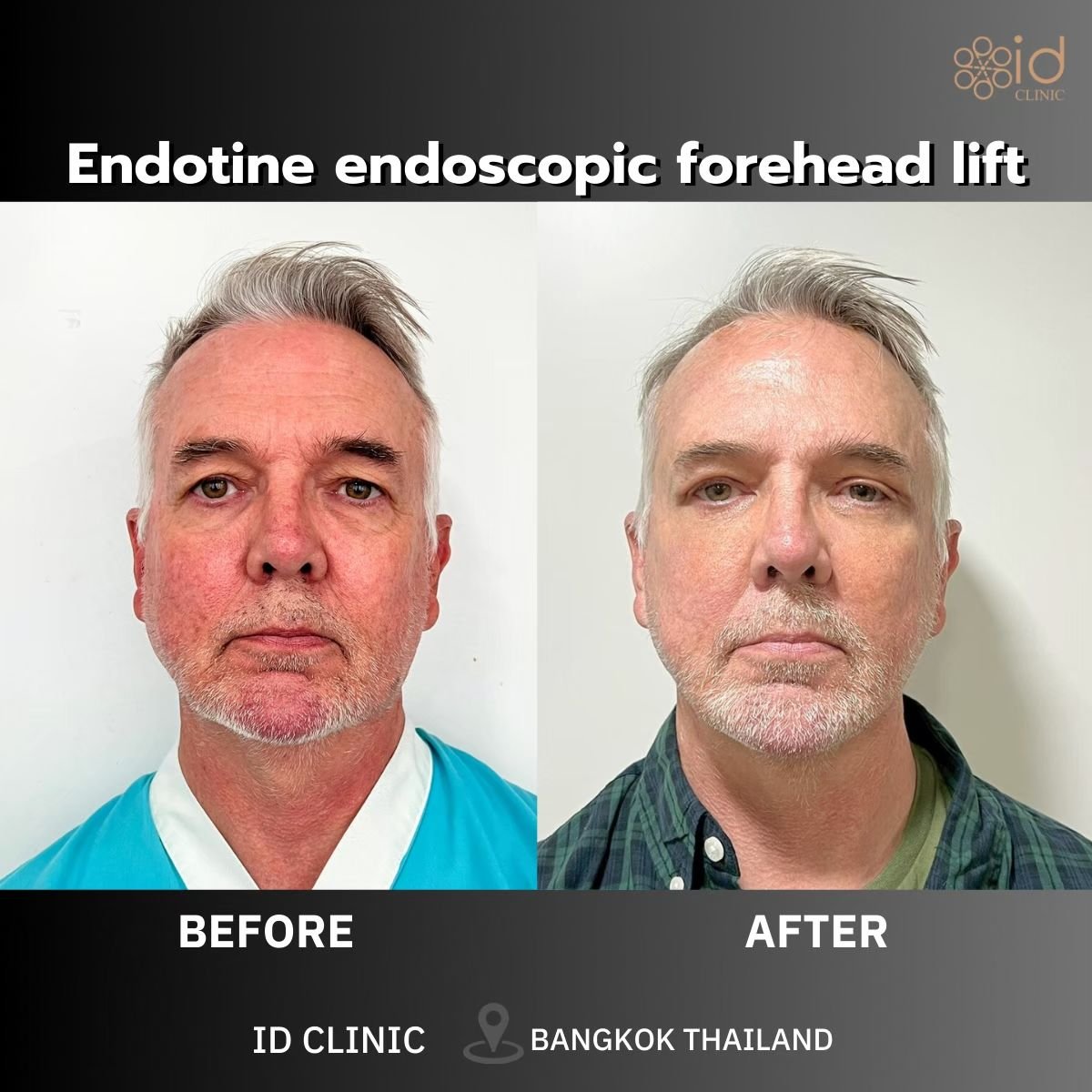Before and after endoscopic forehead lift results at ID Clinic Bangkok, visible brow lift