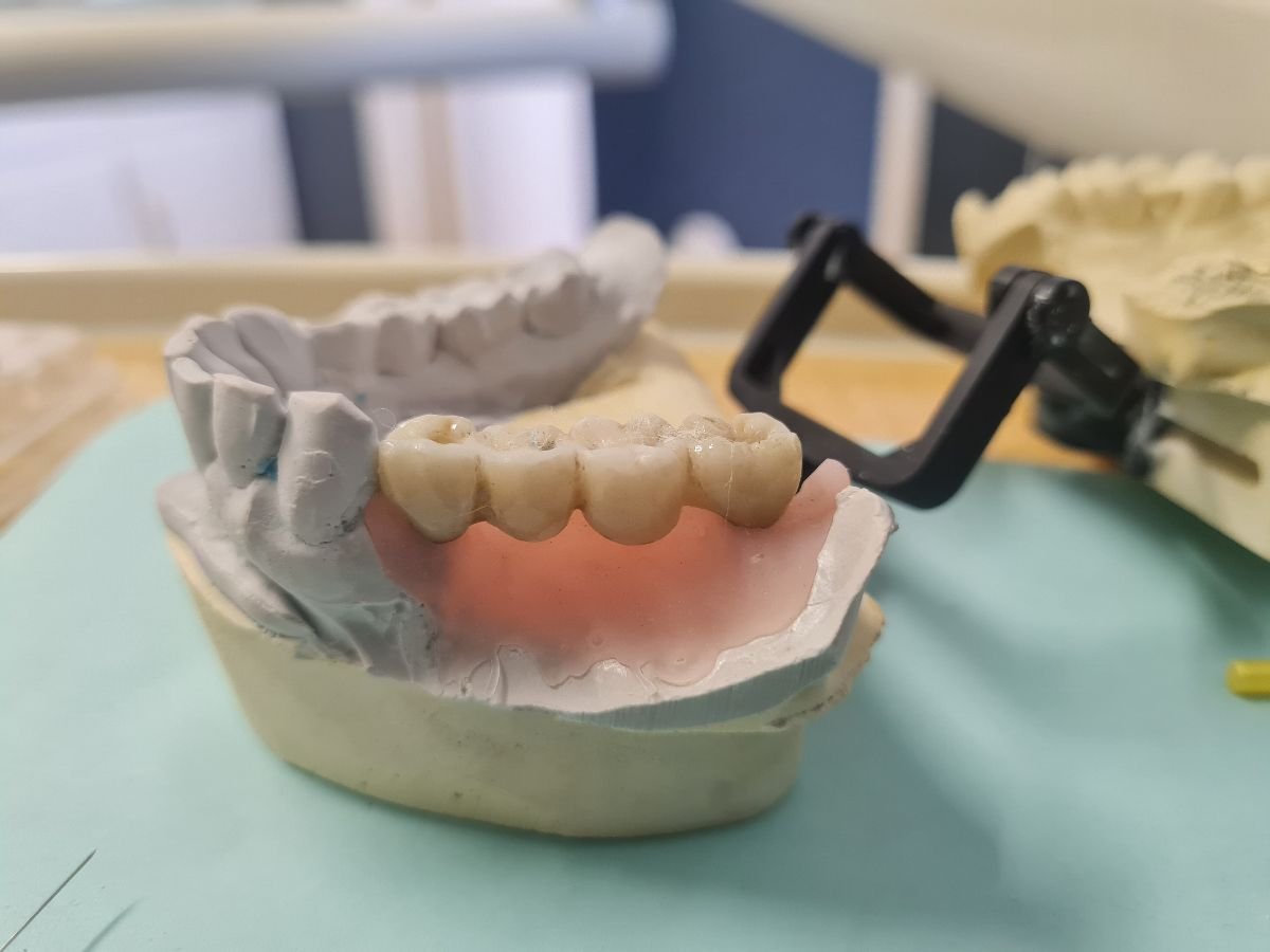 Ergebnis temporärer Zahnbrücke bei SoftDentalCare Clinic, sichtbare Zahnersatzrestauration