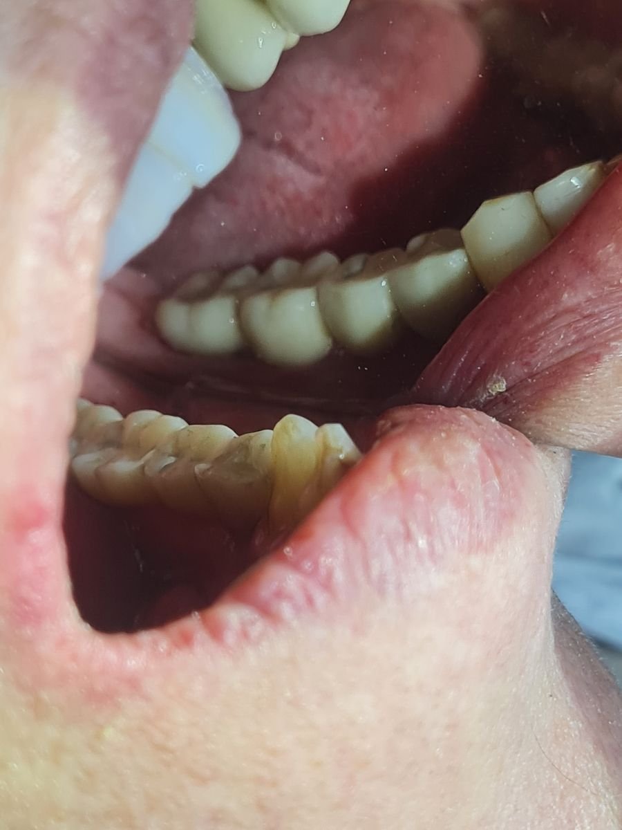 نتيجة جسر أسنان مؤقت في SoftDentalCare Clinic، تحسين مظهر ووظيفة الأسنان