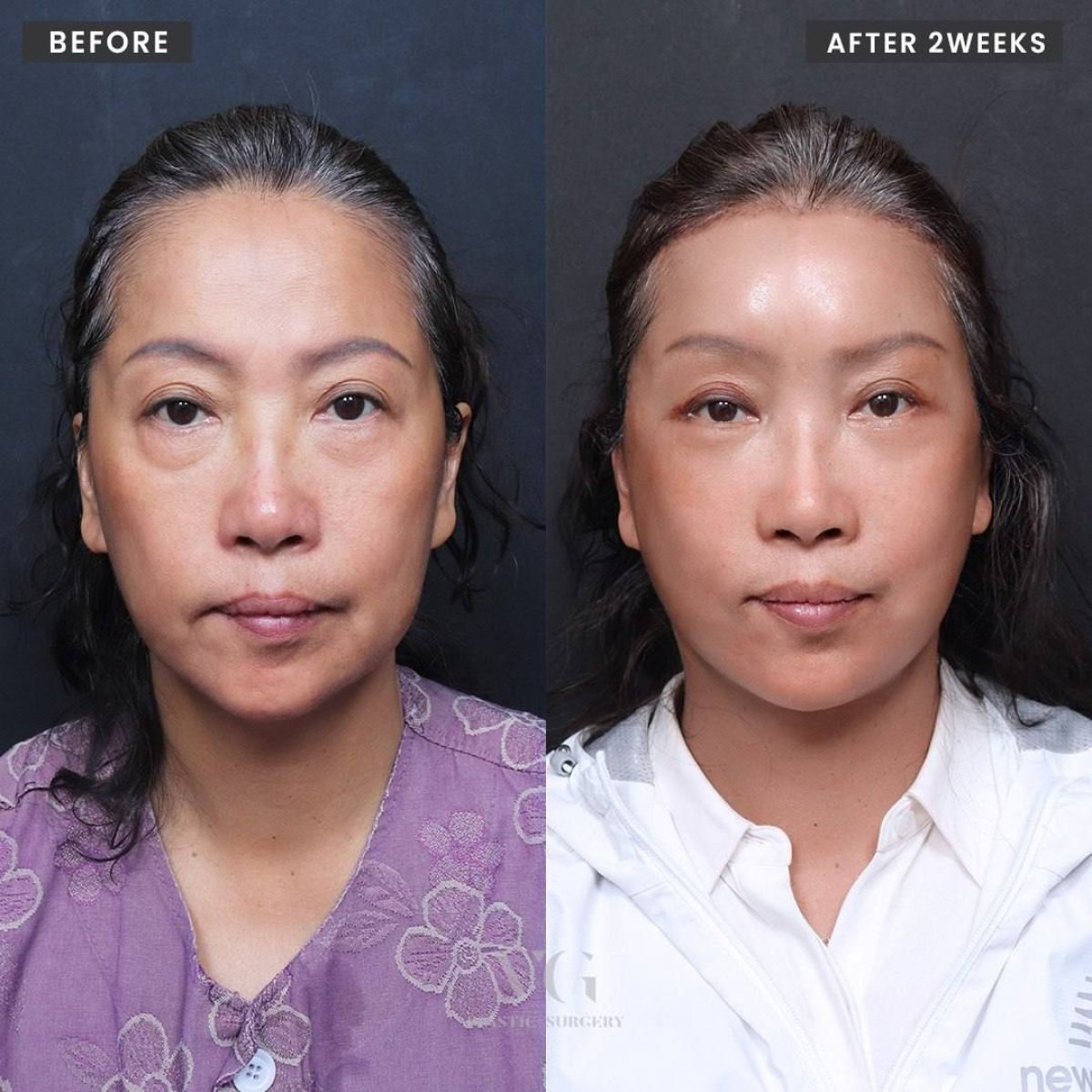 Результаты эндоскопической подтяжки лица до и после в VG Plastic Surgery, омоложение лица