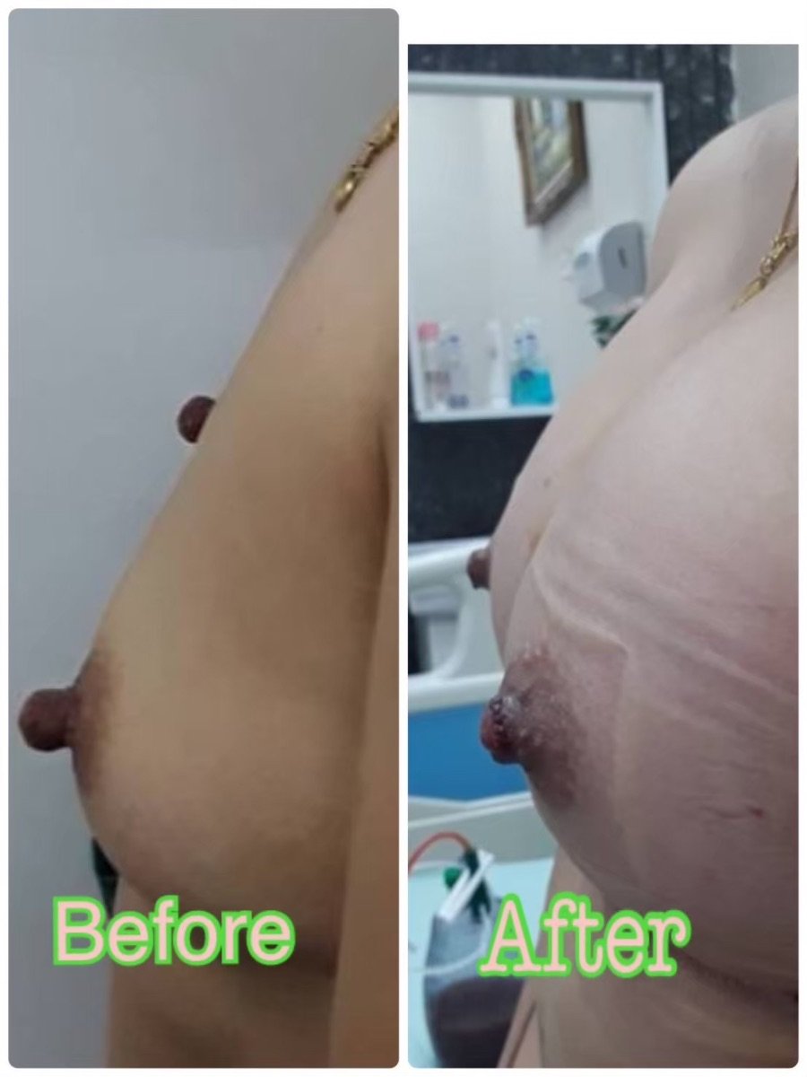 Before and after nipple reduction results at ID Clinic Bangkok, improved nipple appearance