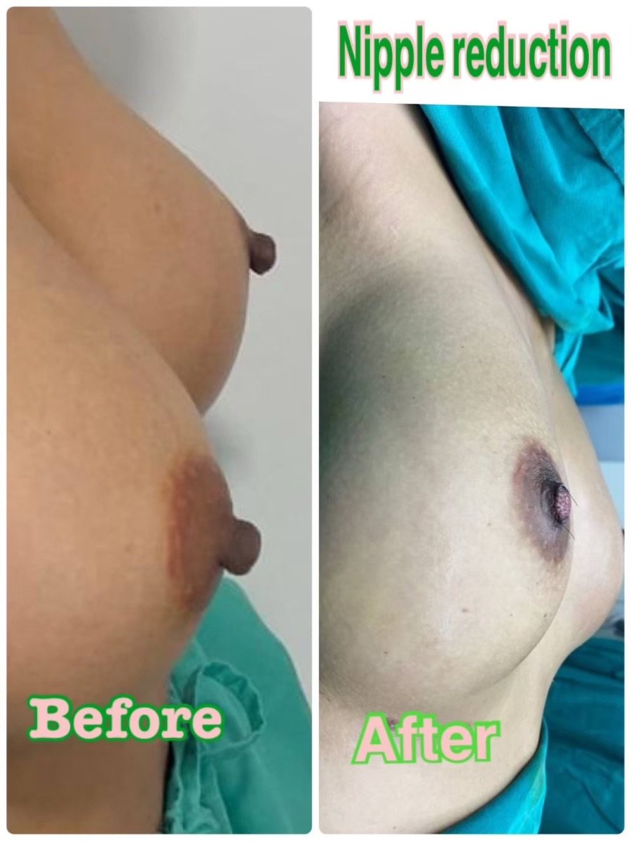 Before and after nipple reduction results at ID Clinic Bangkok – improved nipple appearance