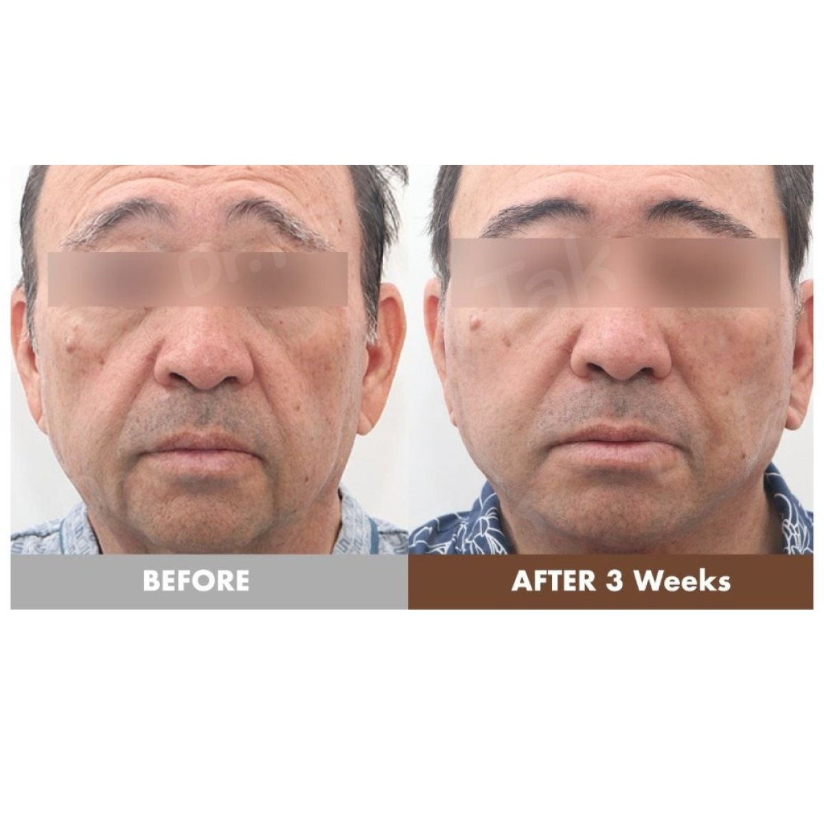 Facelift before and after results at Dr. Tak Plastic Surgery, visible facial rejuvenation in 3 weeks