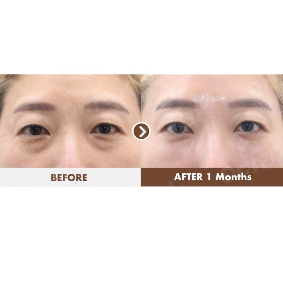 Resultados de blefaroplastia antes y después en Dr. Tak Plastic Surgery, corrección de párpados