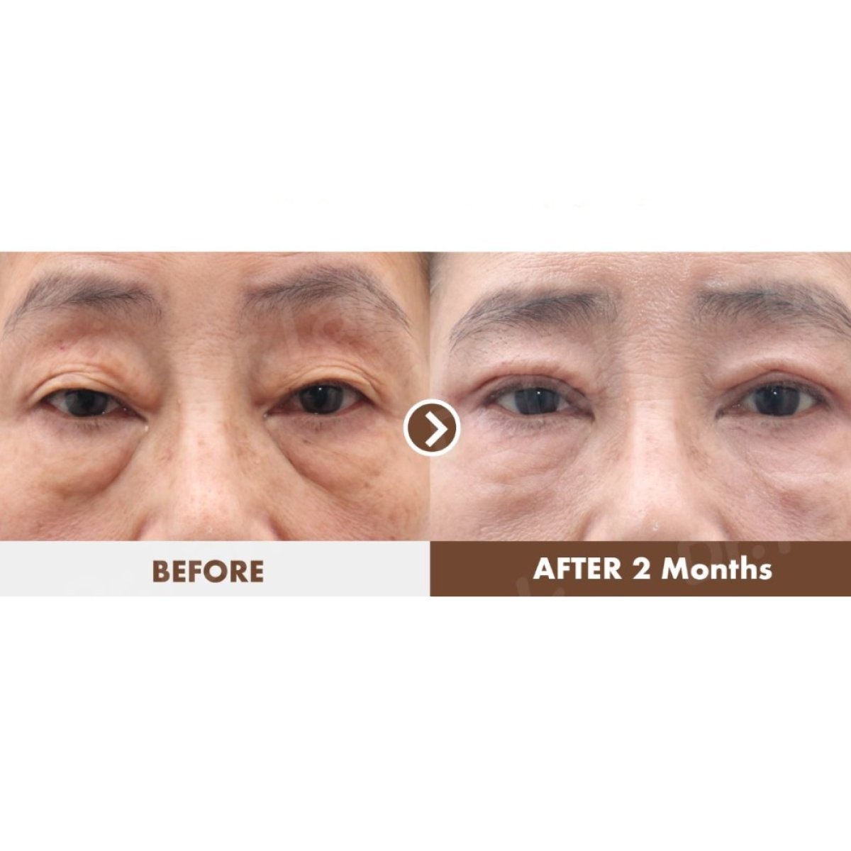 Blepharoplasty before and after results at Dr. Tak Plastic Surgery, eyelid correction improvement
