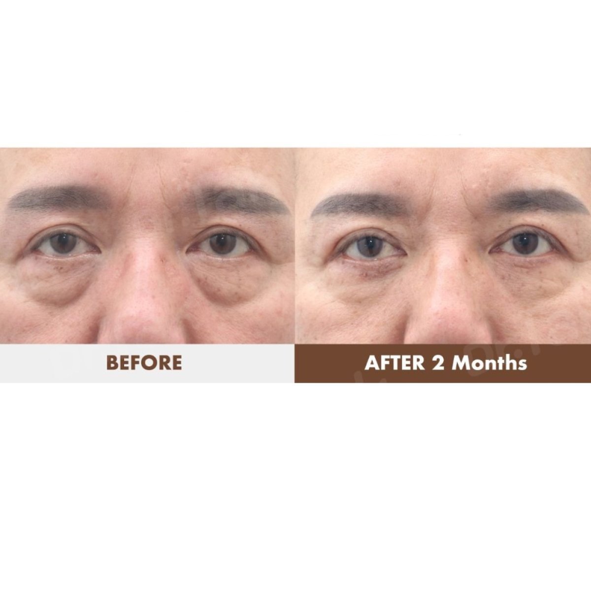 نتائج رأب الجفن قبل وبعد في Dr. Tak Plastic Surgery، تحسين مظهر الجفون