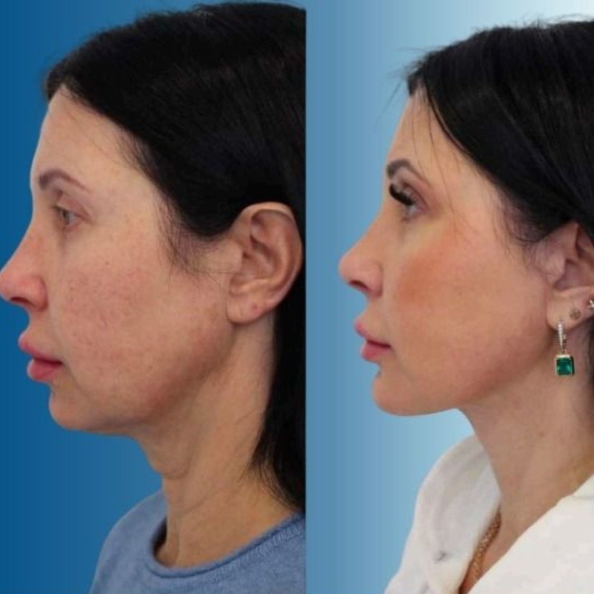Facelift before and after results at Memorial Şişli Hospital – visible facial rejuvenation