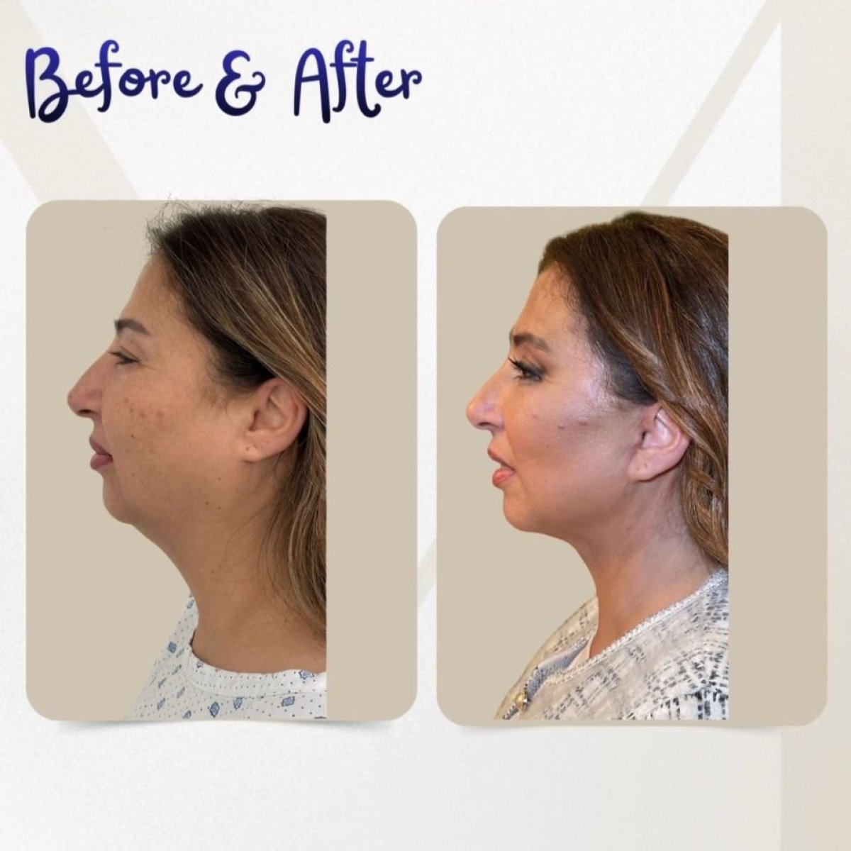 Before and after neck lift results at Dr. Michel Salameh - Plastic And Aesthetic Surgery clinic