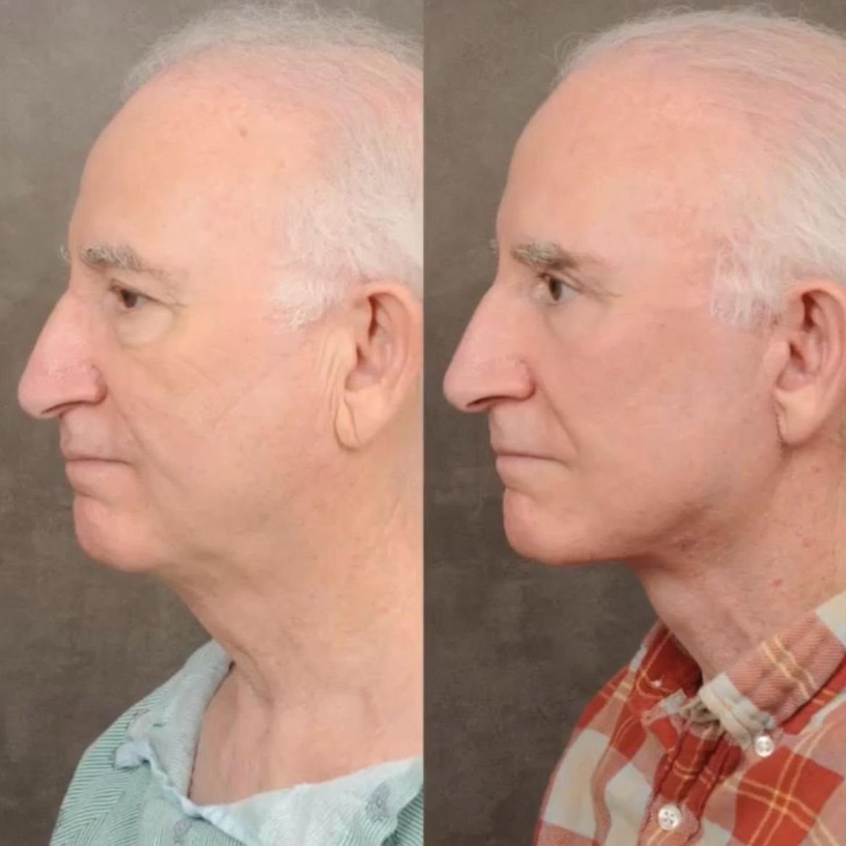 نتائج شد الوجه قبل وبعد في Dr. Alexandro Aguilera - Plastic Surgery، شد الرقبة واضح