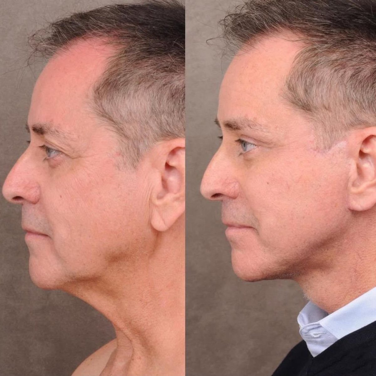 نتيجة شد الوجه قبل وبعد في Dr. Alexandro Aguilera - Plastic Surgery، شد الرقبة واضح