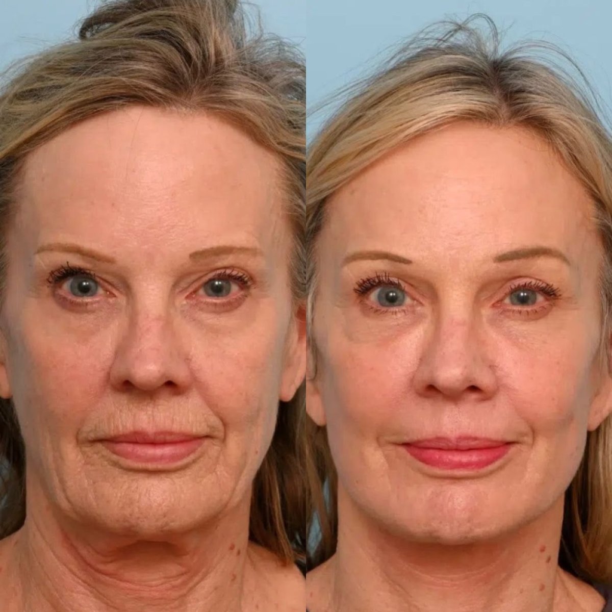نتائج شد الوجه قبل وبعد في Dr. Alexandro Aguilera - Plastic Surgery، تجديد شباب الوجه