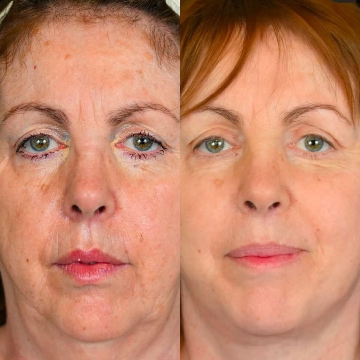 Resultados de lifting facial antes y después en Dr. Alexandro Aguilera - Plastic Surgery