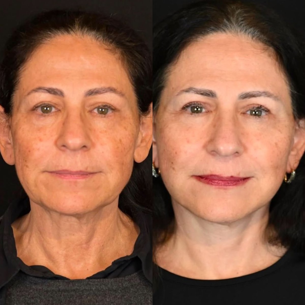 Resultados de lifting facial antes y después en Dr. Alexandro Aguilera - Plastic Surgery