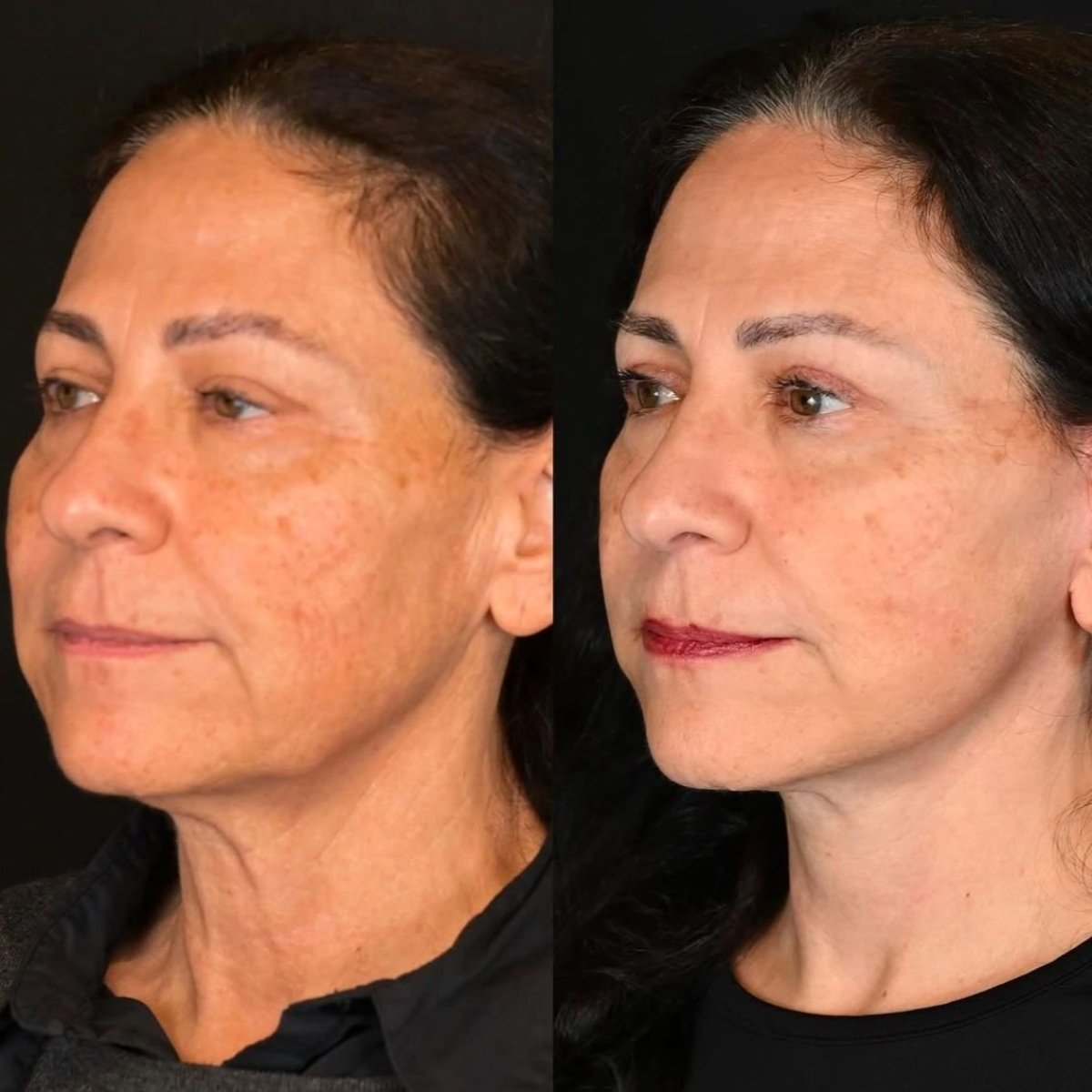 Facelift Vorher-Nachher-Ergebnis bei Dr. Alexandro Aguilera - Plastic Surgery, Verjüngung