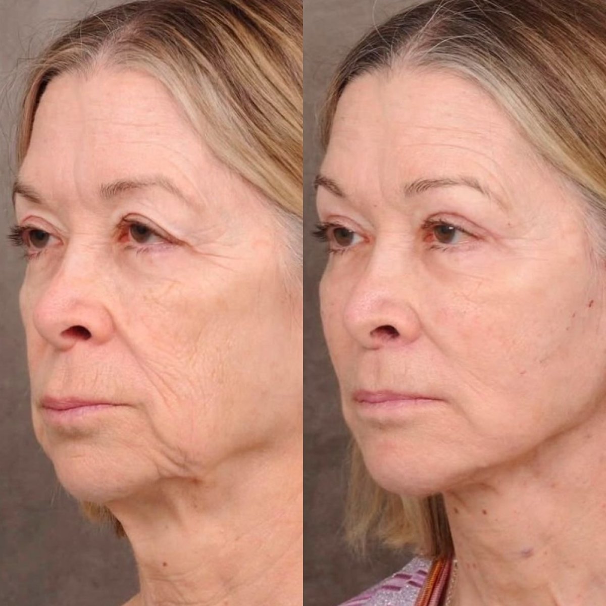Resultados de lifting facial antes y después en Dr. Alexandro Aguilera - Plastic Surgery