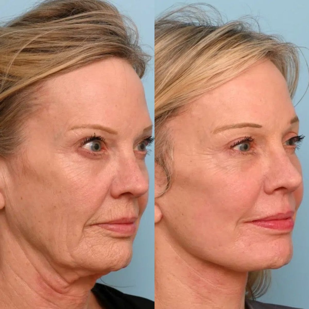 نتائج شد الوجه قبل وبعد في Dr. Alexandro Aguilera - Plastic Surgery، تجديد شباب الوجه