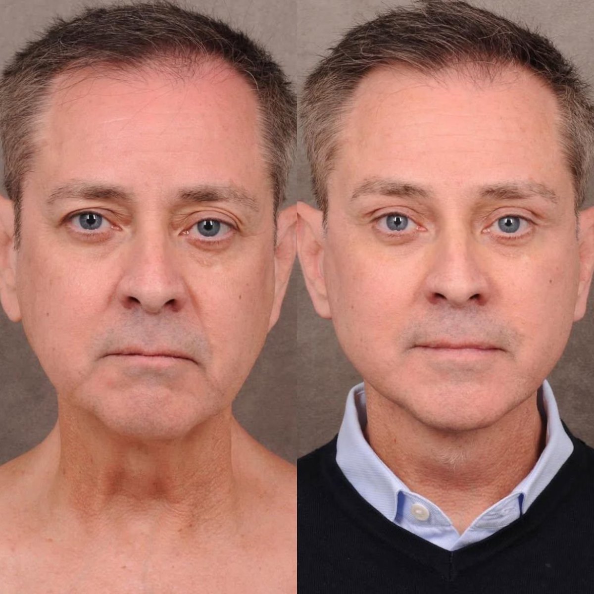 نتائج شد الوجه قبل وبعد في Dr. Alexandro Aguilera - Plastic Surgery، تجديد شباب الوجه