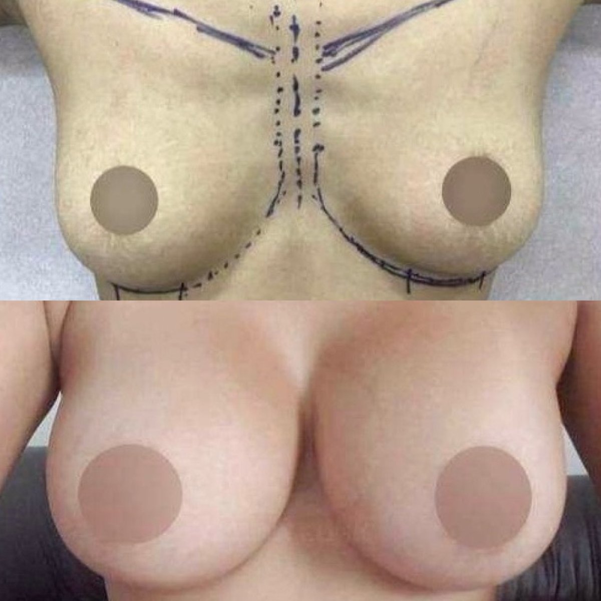 Before and after breast augmentation results – enhanced breast size and contour improvement