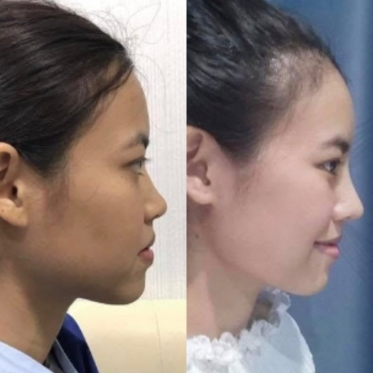 Résultats avant et après rhinoplastie, profil du nez amélioré et harmonie du visage