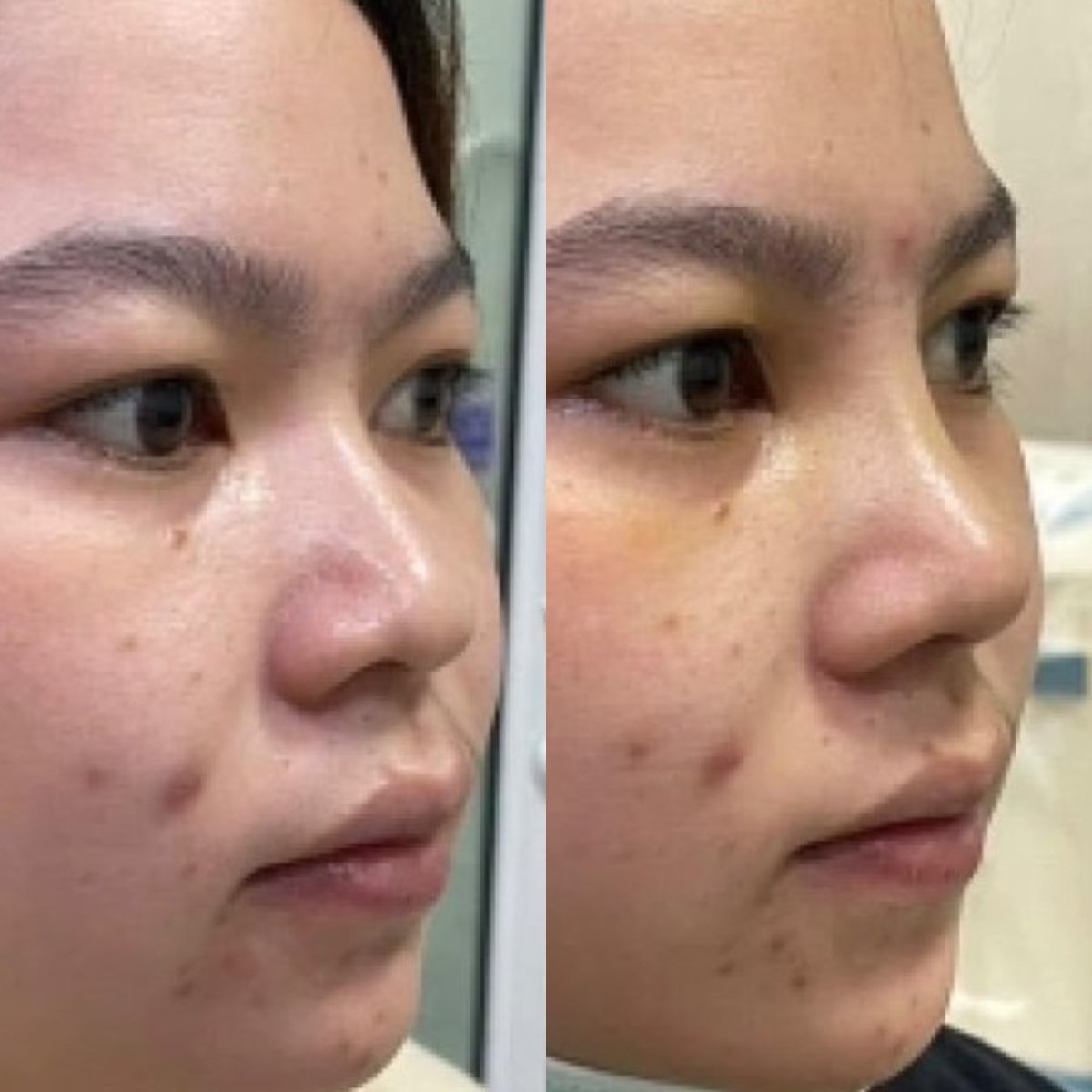 نتائج عملية تجميل الأنف قبل وبعد، تحسين شكل الأنف وتناسقه