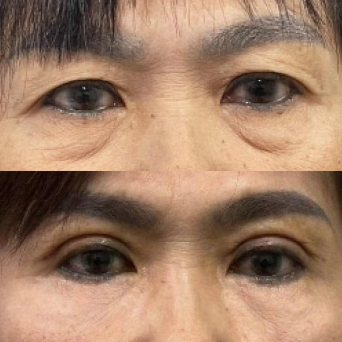 Before and after upper and lower eyelid surgery results – rejuvenated eye area appearance