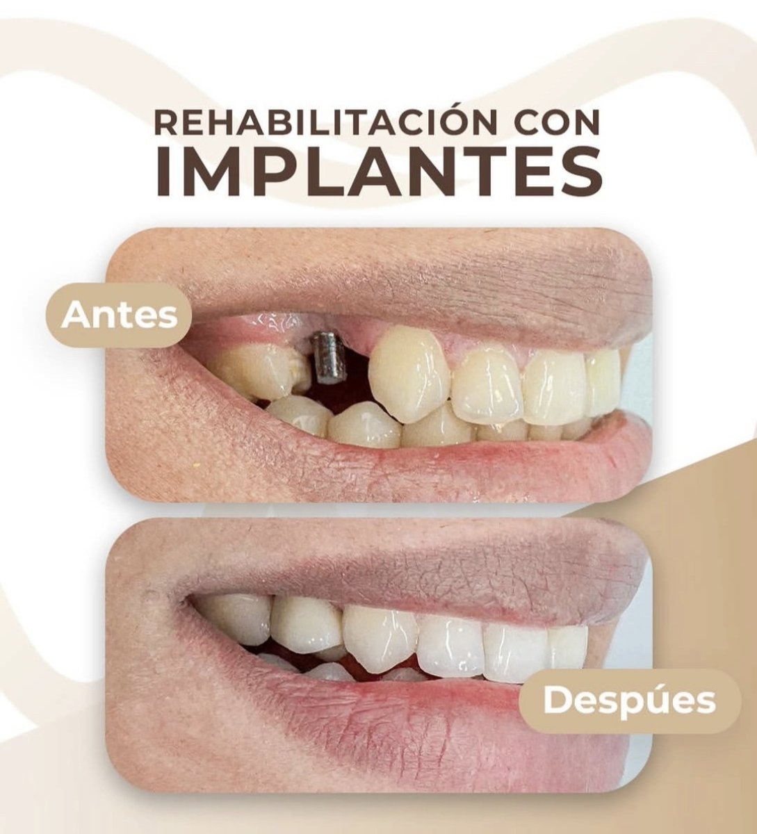 نتائج قبل وبعد زراعة الأسنان في Punta cana dentist odontologia familiar، ابتسامة محسنة