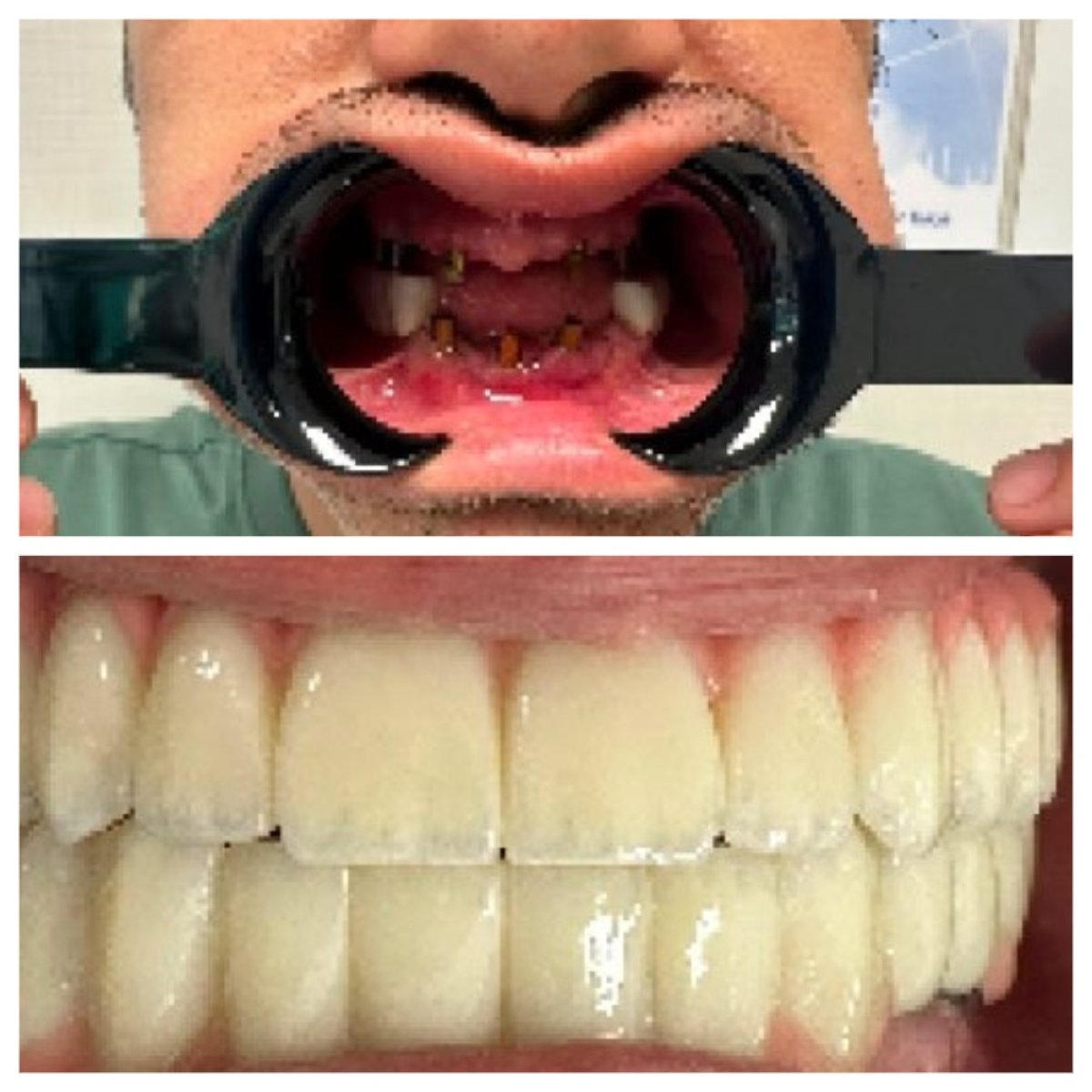 نتيجة قبل وبعد زراعة الأسنان All-on-6 في عيادة Ader Dent Oral and Dental Health