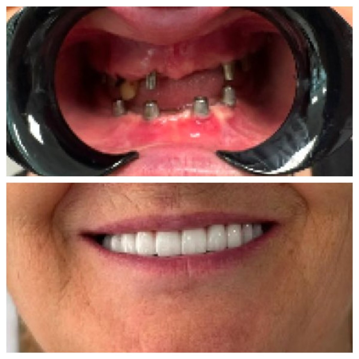 نتيجة قبل وبعد زراعة الأسنان All-on-6 في عيادة Ader Dent Oral and Dental Health Clinic