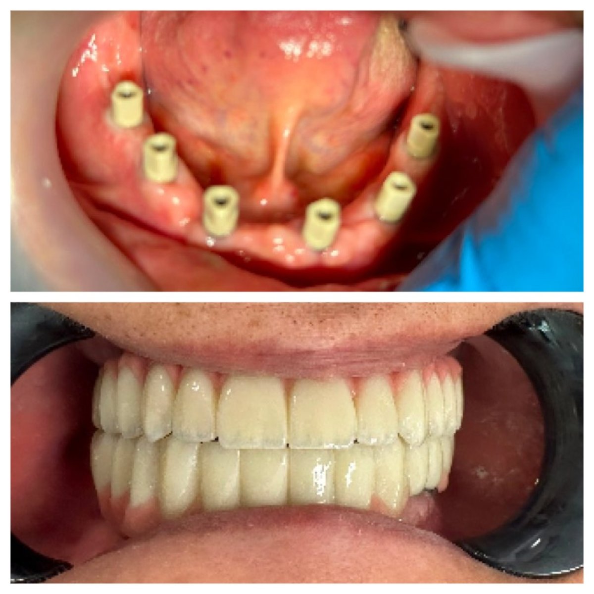 نتيجة قبل وبعد زراعة الأسنان All-on-6 في عيادة Ader Dent Oral and Dental Health Clinic
