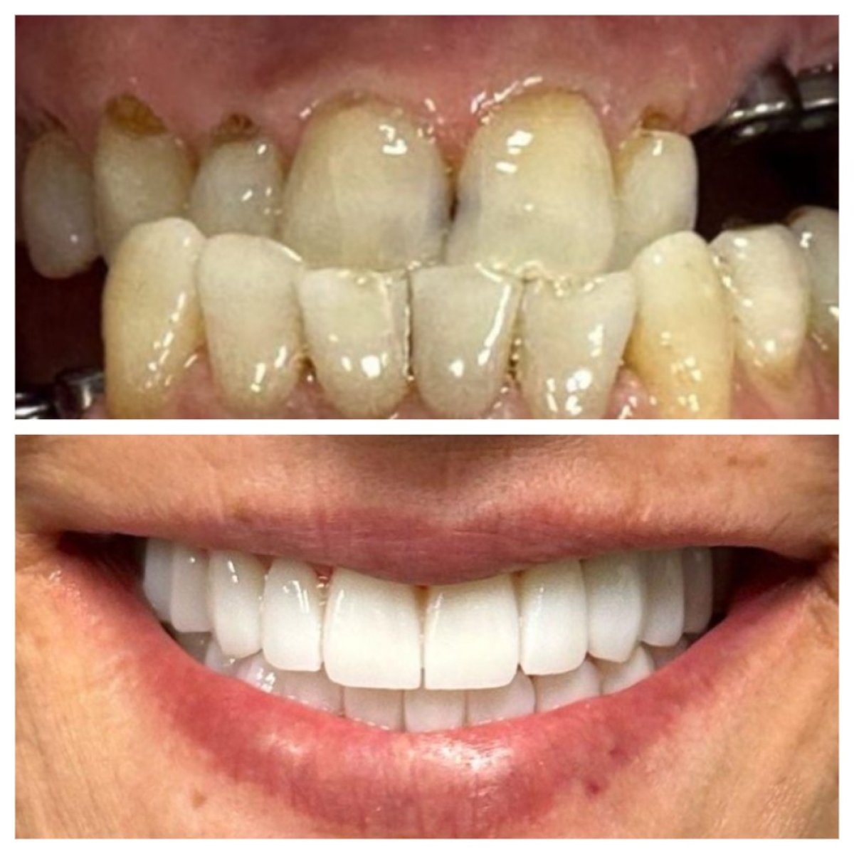 نتائج قبل وبعد زراعة الأسنان في عيادة Ader Dent Oral and Dental Health Clinic، ابتسامة مستعادة