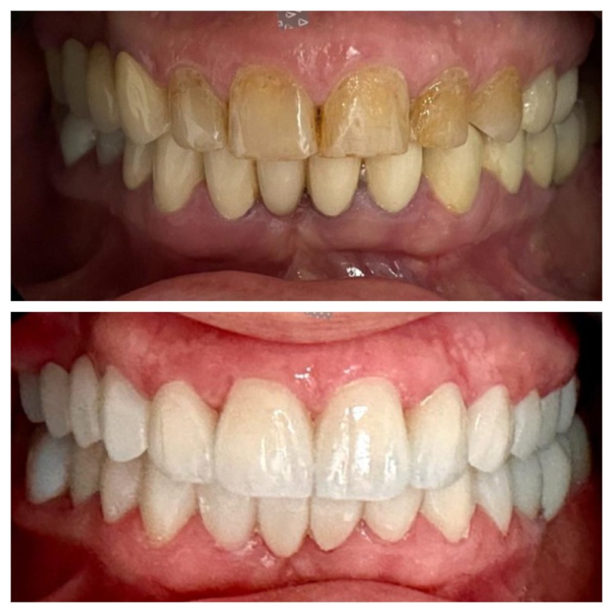 Результаты до и после Hollywood Smile в Ader Dent Oral and Dental Health Clinic, белые зубы