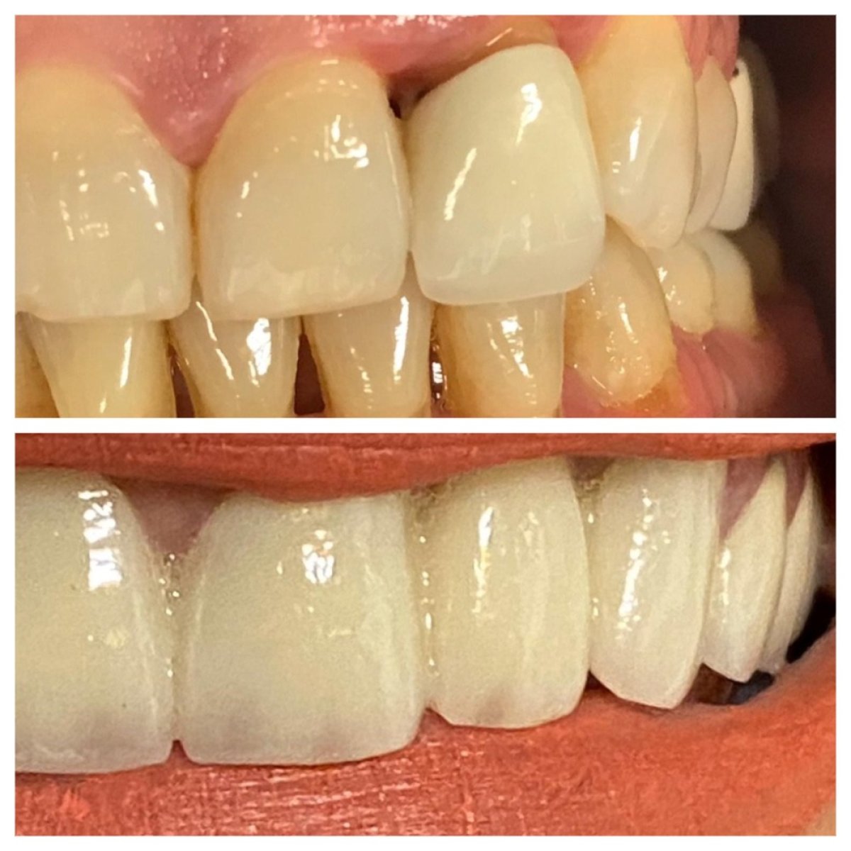 Resultados antes y después de coronas de zirconio en Ader Dent Oral and Dental Health Clinic, sonrisa renovada