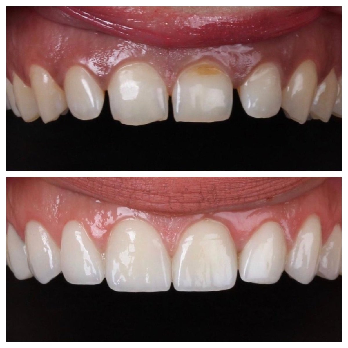 Результаты до и после установки циркониевых коронок в Ader Dent Oral and Dental Health Clinic