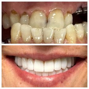 Premium Zirconia Crown Treatment – Single Tooth - photo 4