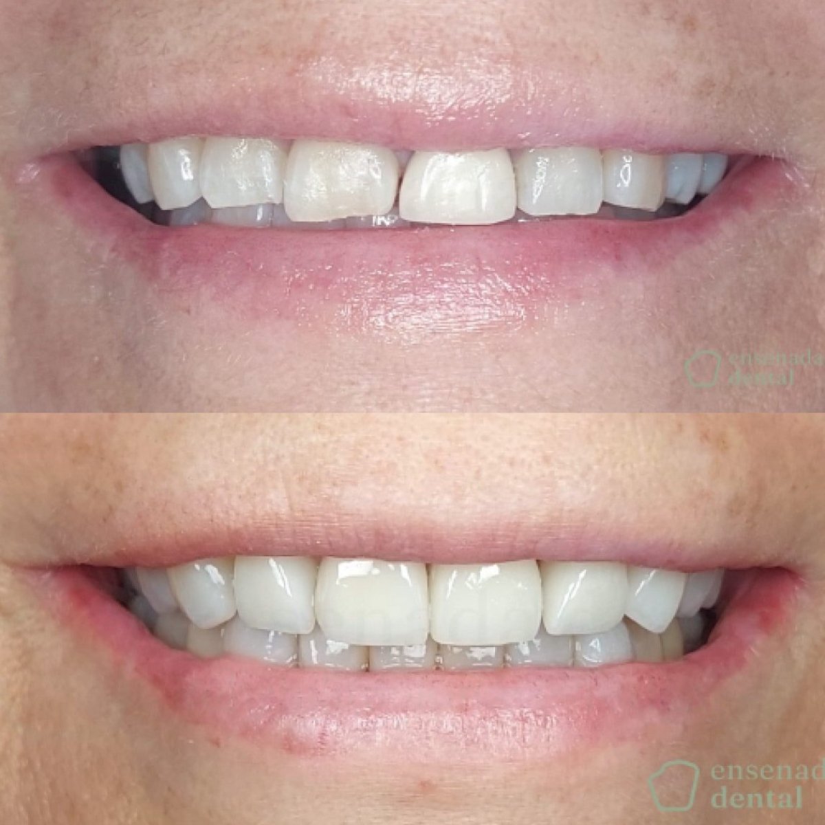 Результати до і після зміни усмішки в Ensenada Dental – вирівнювання та відбілювання зубів