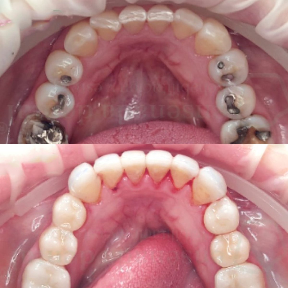 Before and after smile makeover results – dental restoration and cavity treatment visible