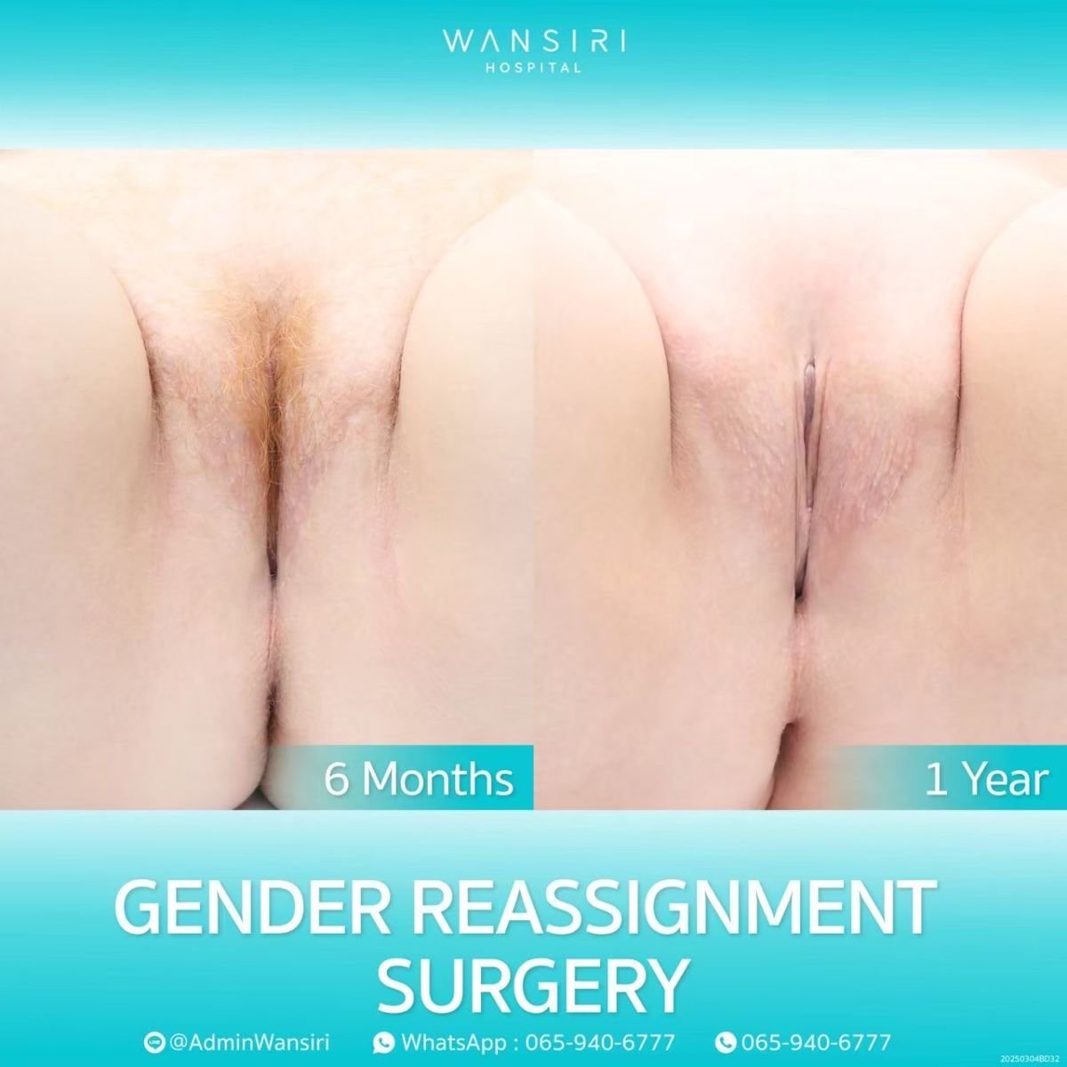 MTF gender reassignment surgery results at Wansiri Hospital, 6 months vs 1 year post-op