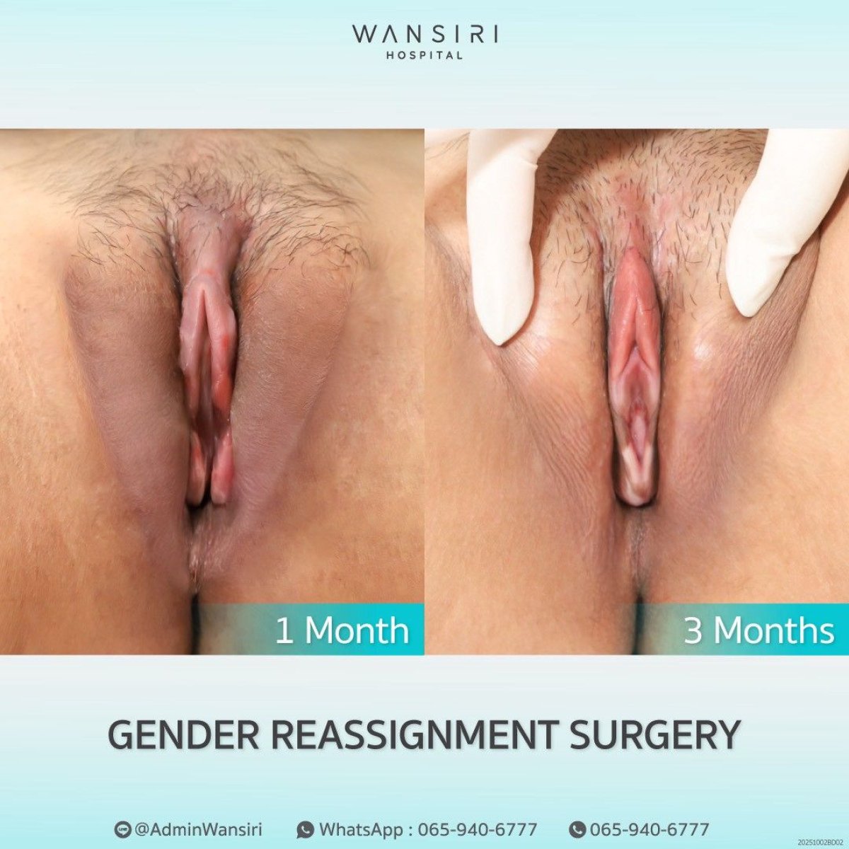 Résultats de chirurgie MTF à Wansiri Hospital, 1 mois vs 3 mois après l’opération