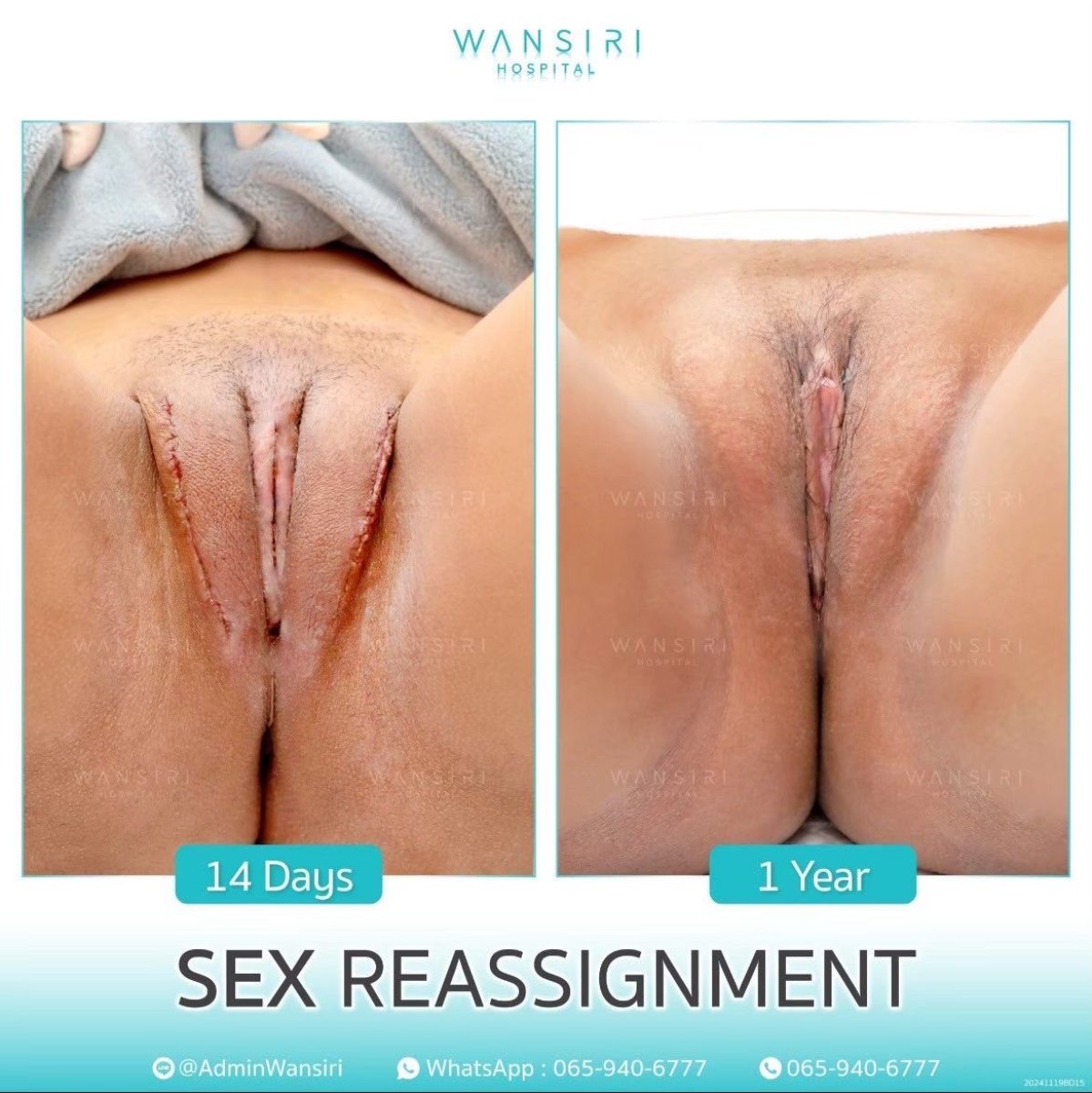 Résultats de chirurgie MTF à Wansiri Hospital – cicatrisation de 14 jours à 1 an