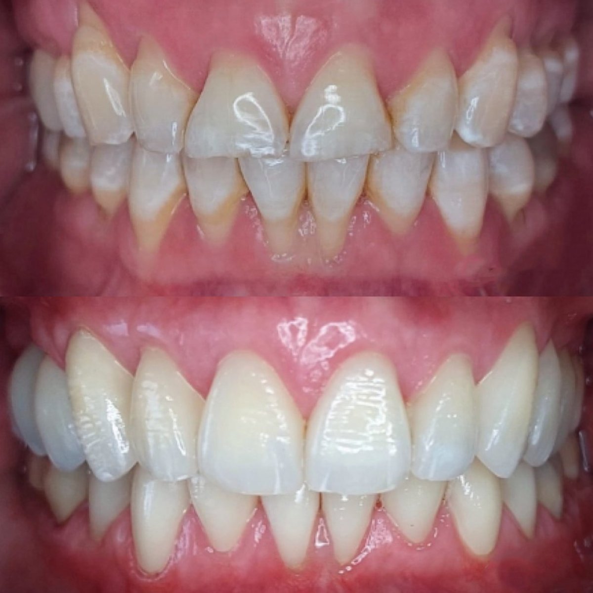 Smile makeover before and after results – whiter, straighter teeth after dental treatment