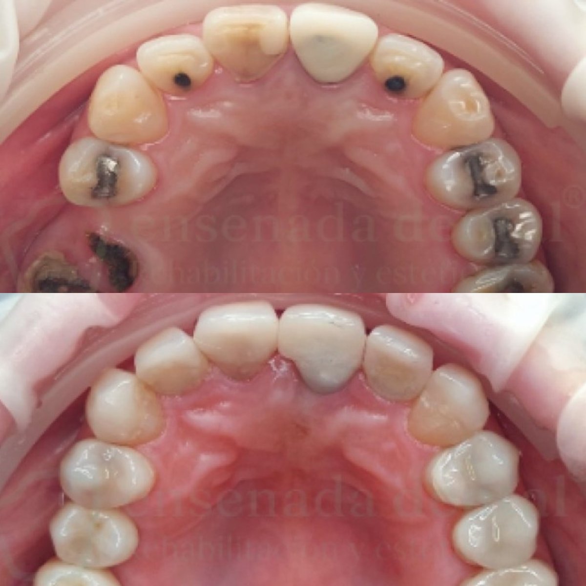 Результаты до и после smile makeover – восстановление зубов и лечение кариеса