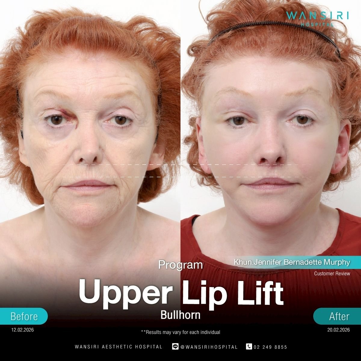 Before and after upper lip lift results at Wansiri Hospital, visible lip contour improvement